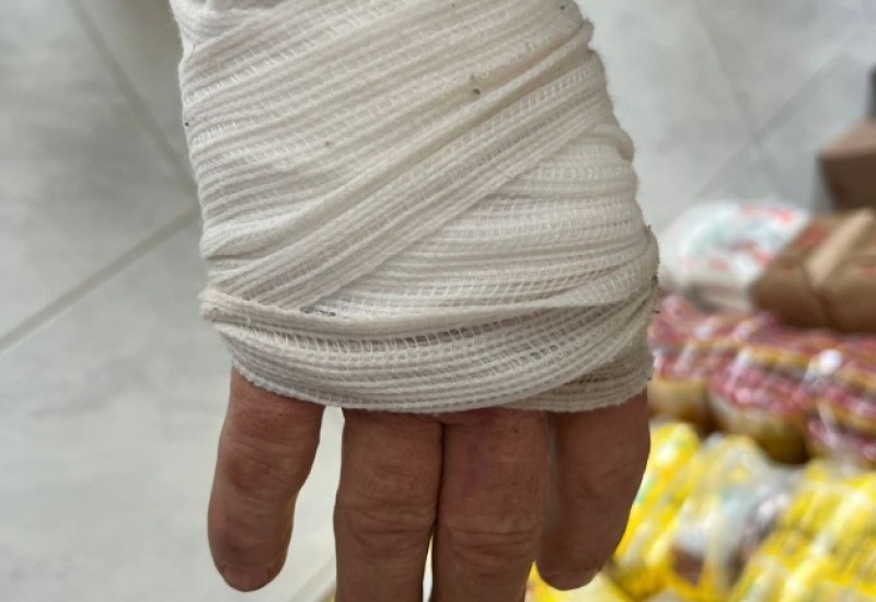 Empresário teve a mão ferida ao ser agredido por assaltantes (Foto: Ederson Abi/Rádio Líder)